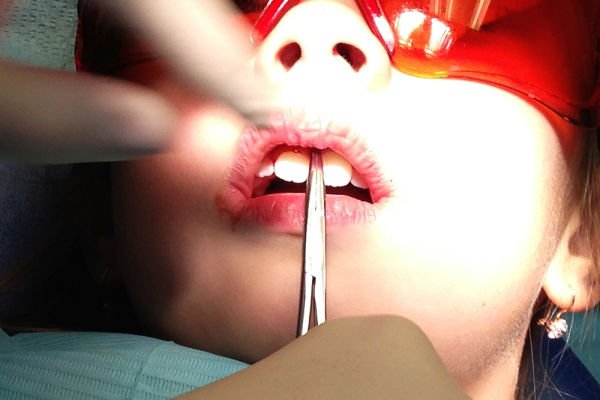 Аперацыя па пластыцы верхняй губы ў дзяцей