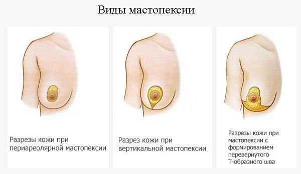 віды мастопексии