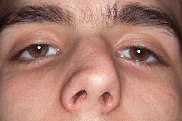 Дэфармацыя носа пасля рынапластіка