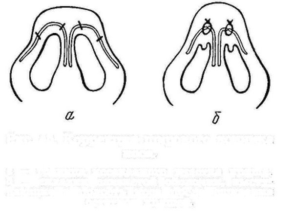 Схематычны малюнак сшывання храсткоў кончыка носа